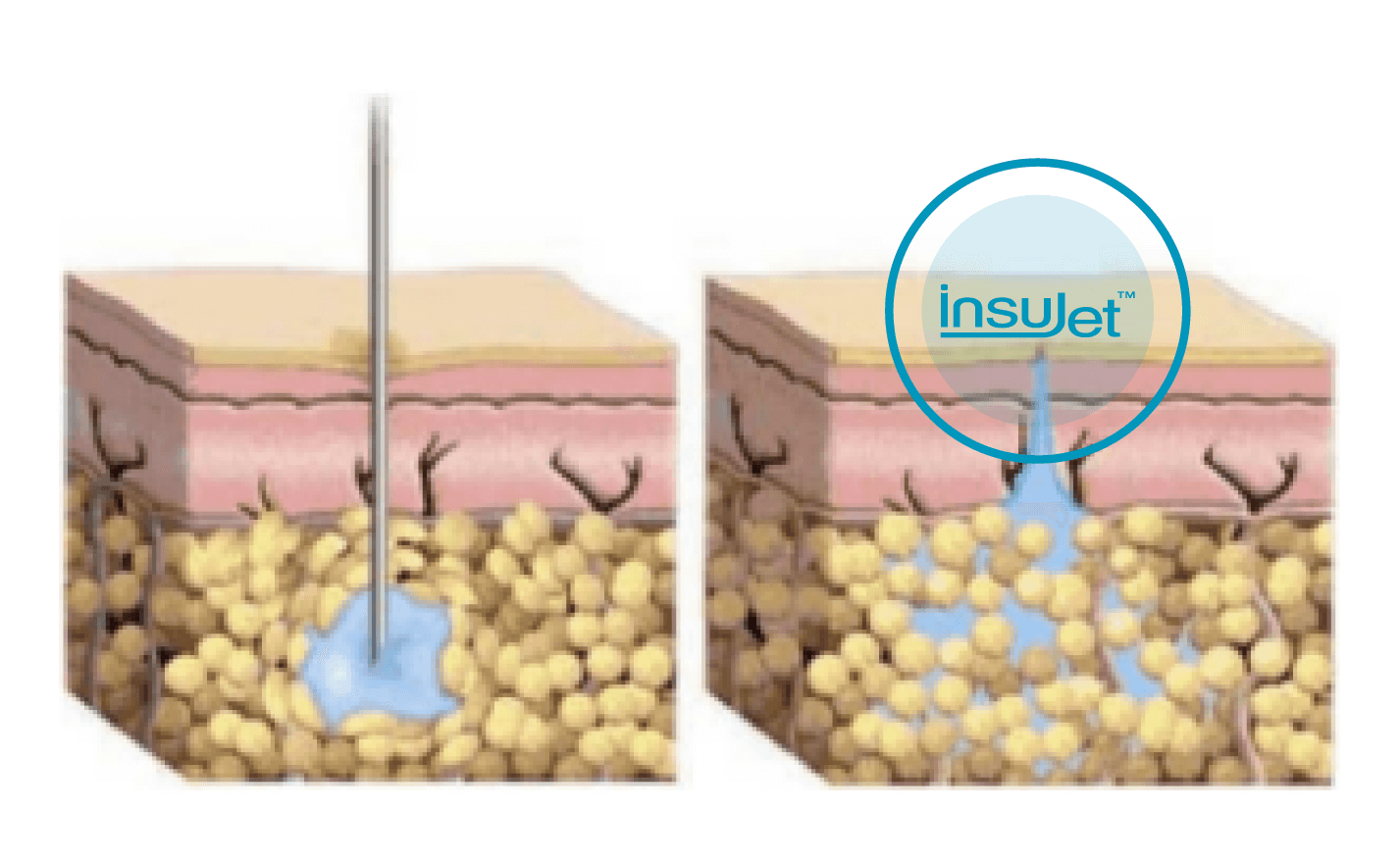 InsuJet Store - Needlle-free Insulin Jet Administration System